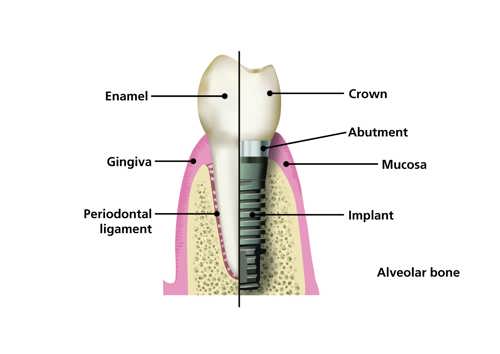 The anatomical differences between a tooth and a dental implant